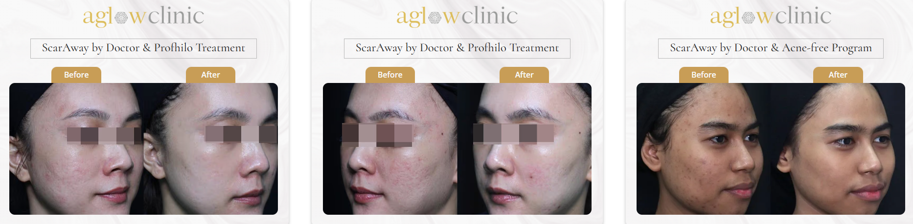 Acne scar before and after KL result 2